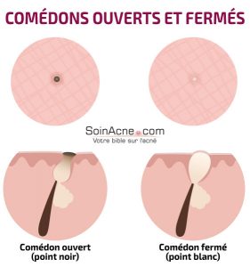 comédons ouverts et fermés