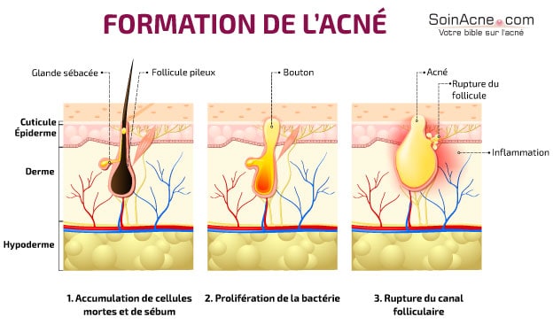 Acn Inflammatoire D finition Caract ristiques Et Traitements Acn Inflammatoire D finition Caract ristiques Et Traitements
