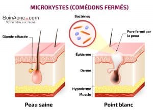 formation of closed comedones (microcysts)