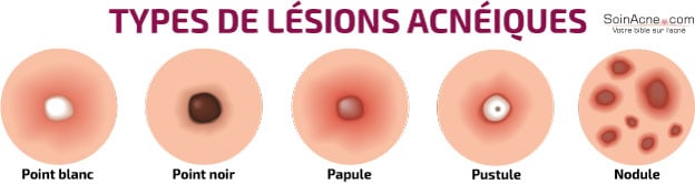 types de lésions acnéiques