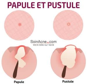 diferencia entre pápula y pústula