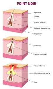 blackhead